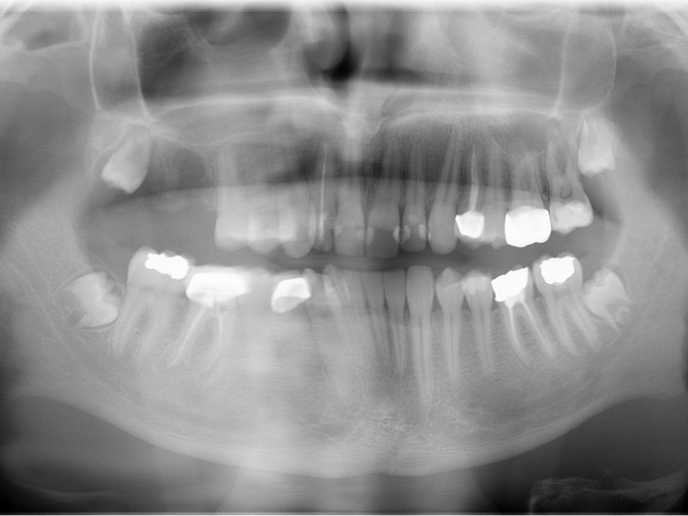 Präoperatives OPG - Pat-Fall 1