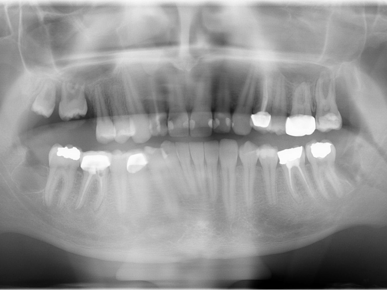 Postoperatives OPG - Pat-Fall 1