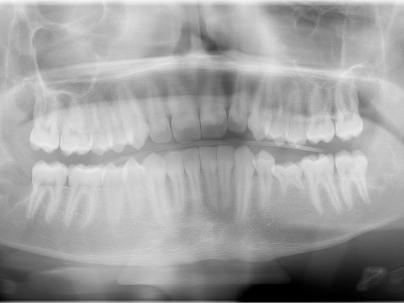 Postoperatives OPG - Pat-Fall 2