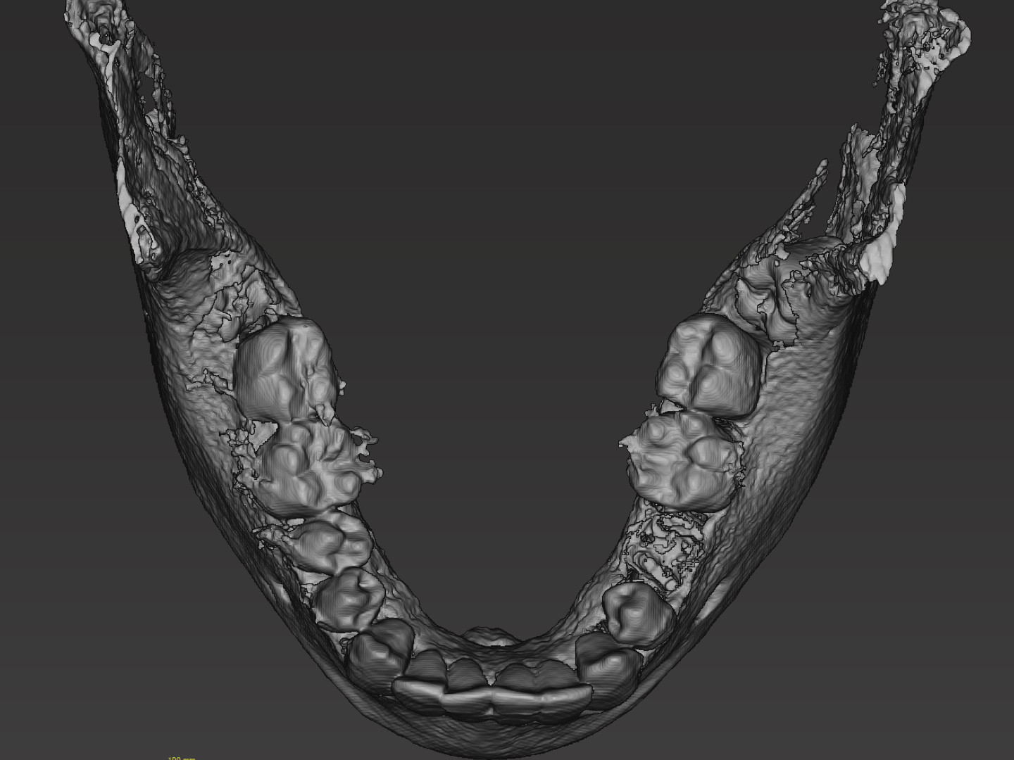 Segmentierter Unterkiefer