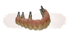 Brücke mit Zahnfleischanteil auf individuellen Abutments auf 6 Implantaten