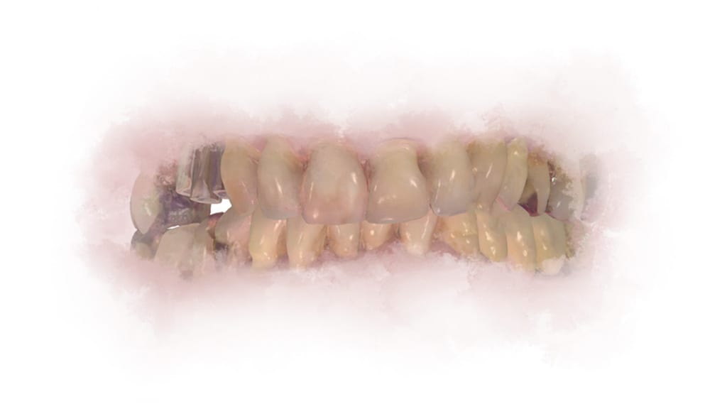 Ein Intraoraler Scan